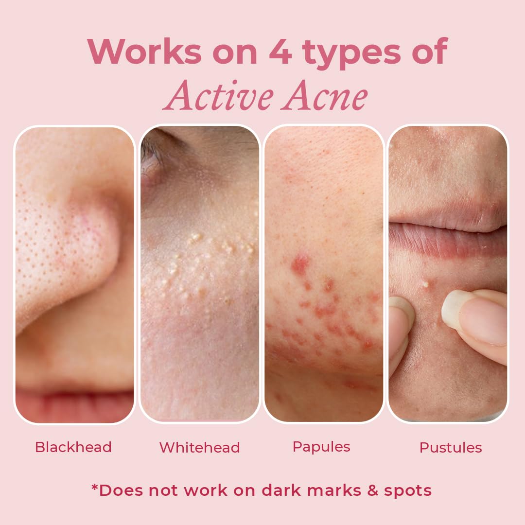 The Pink Foundry Acne Spot Corrector With Salicylic Acid For Active Acne, Blackheads & Whiteheads (15ml)