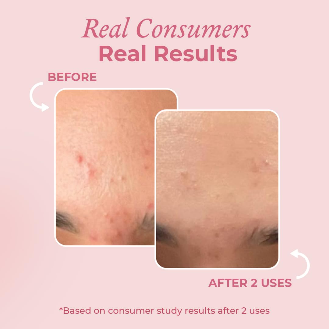 The Pink Foundry Acne Spot Corrector With Salicylic Acid For Active Acne, Blackheads & Whiteheads (15ml)