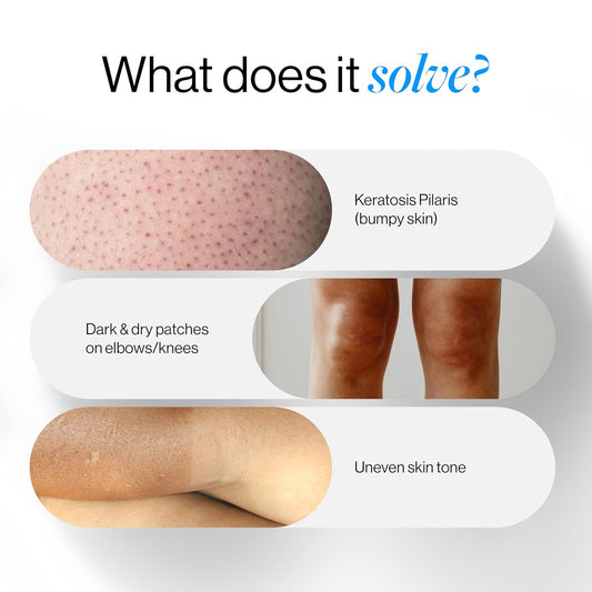 BeBodywise 5% Lactic Acid Body Lotion - 200 ml