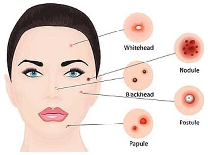 Dr Bhushan’s Acne & Pimples therapy Kit