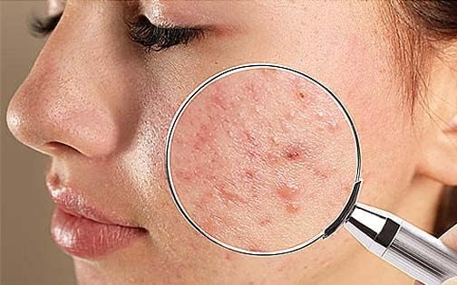 Dr Bhushan’s Acne & Pimples therapy Kit