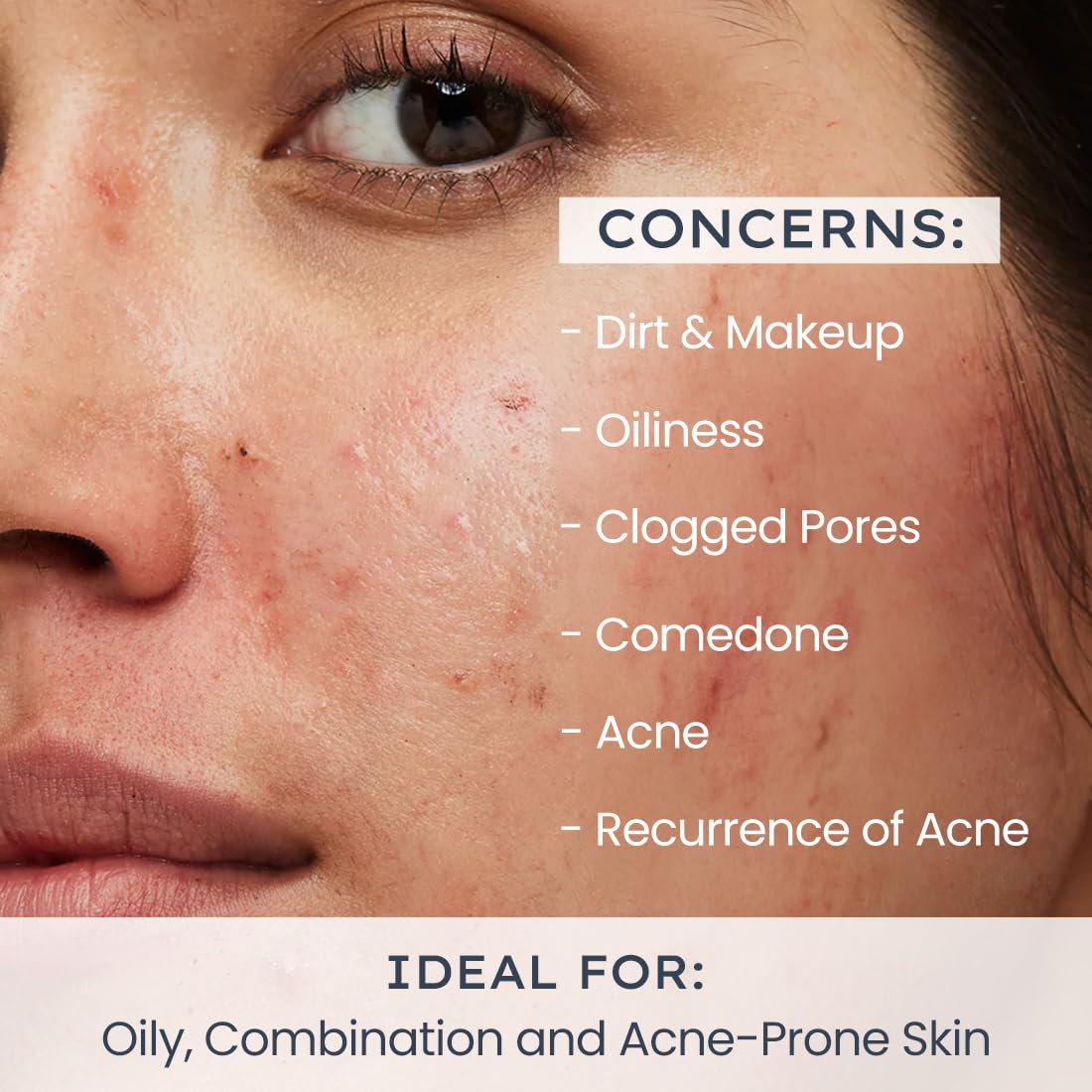 Hyphen Oil Control Daily Exfoliating Cleanser 2% AHA + BHA Salicylic Acid Face Wash For Oily Skin & Acne (100ml)